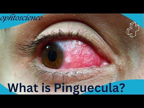 what is pinguecula? |symptoms, sign, treatment, preventions
