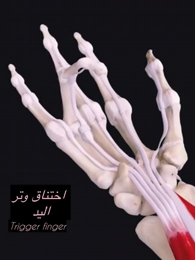 👌اختناق الوتر (Trigger Finger) أو