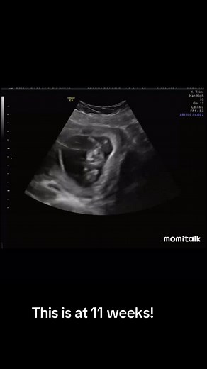 Can’t believe we are 33 weeks tomorrow! 🩷 cant wait to meet them so so soon! #triplets #ultrasound #pregnant