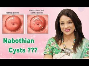 What are Nabothian cyst?