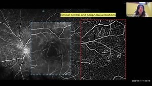 48th Annual Macula Society Meeting Insights: Fern-Like Retinal Vasculopathy in Intermediate Uveitis