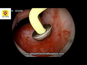 tuvp turp (BIPOLAR) transurethral resection of prostate DR AVINASH SHAHARE