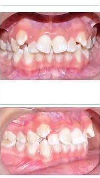 CLASS II LOW ANGLE 😱 CLINICAL TIPS THAT CHANGE THE OUTCOME