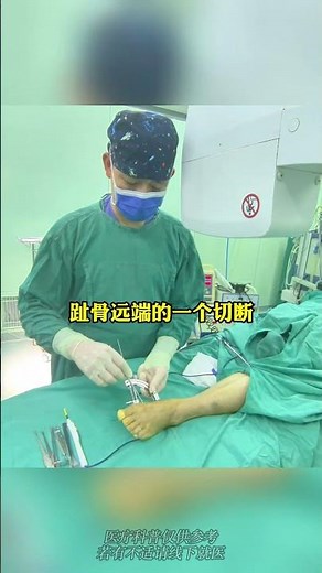 拇外翻合并副舟骨微创，过程揭秘 Minimally Invasive for Hallux Valgus with Accessory Navicular — Procedure Revealed