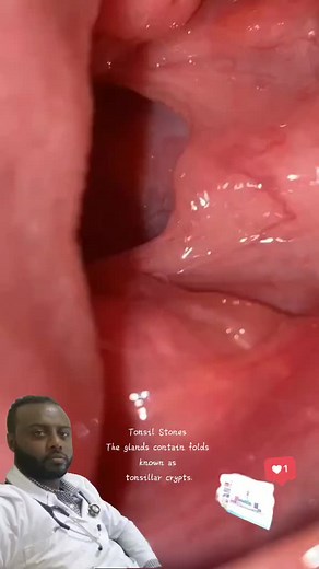 The glands contain folds known as tonsillar crypts (folds). If your tonsillar crypts are enlarged, minerals such as calcium can become trapped, and calcify (harden) into stones. Bacteria or fungi that cause tonsillitis can also cause tonsil stones to form.