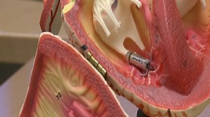 Tiny pacemaker giving hope to some Cleveland Clinic cardiac patients