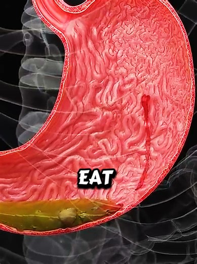These are the best foods to eat if you have ulcers #healthcare #lifehack #viralvideo #usa🇺🇸