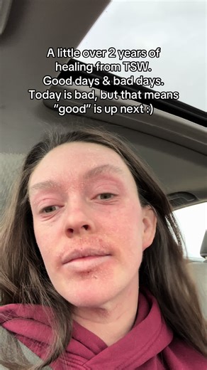 Healing Journey Through Topical Steroid Withdrawal