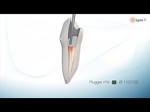 Root canal obturation: System B