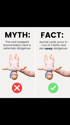 A nuchal cord is a medical way of saying that baby’s cord is wrapped around their neck. ⁣⁠ ⁣⁠ This is something you’ve probably heard about and you may even know someone who had this happen during their birth. ⁣⁠ ⁣⁠ ❗This isn’t at all surprising because nuchal cords are actually quite common – occurring in a little more than 1 in 3 births!⁣⁠ ⁣⁠ And even though the idea of the cord being wrapped around the neck seems very scary, in reality, the chance of any complications is rare. ⁣⁠ ⁣⁠ Sometimes