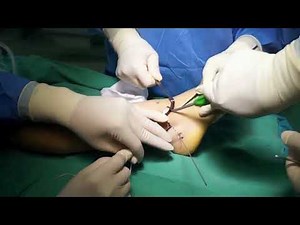 Foot & Ankle International - Lateral Ligament Augmentation Using Suture-Tape