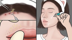 Blackheads and whiteheads on face can always be annoying😡 Let's see how to remove blackheads and pimples with tweezer and other tools PS：Some steps demonstrated in this asmr animation treatment may not be professional, please DO NOT IMITATE if you have similar blackhead problems. #asmr #skincare #animation #spa | Meng's Stop Motion