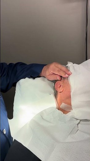 Dr. B Shows Large Cyst on Face (part 1) #dermatology #cyst #cystremoval