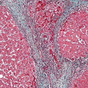 Testing for Liver Disease, Before Symptoms Appear | Clinical And Molecular Dx