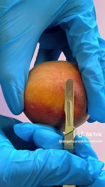 Dermaplaning Techniques Inspired by TSITP