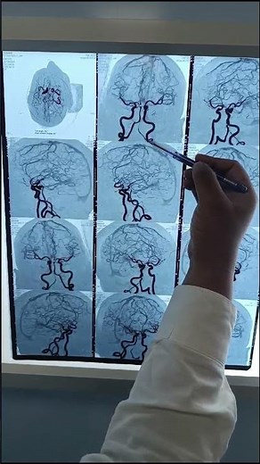 Exploring Internal Carotid Anatomy in 40 SECONDS on a CT Angiogram?