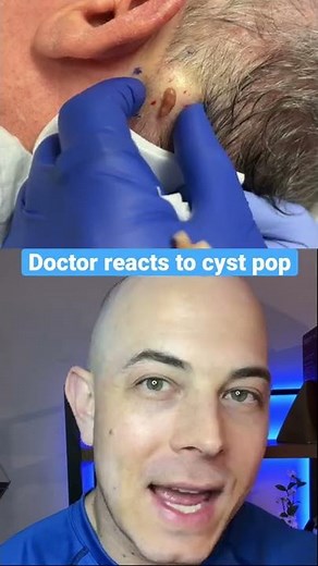 AMAZING Cyst Pop! | 208SkinDoc