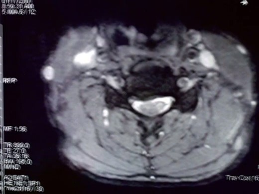 Cervical Myelopathy Cloward