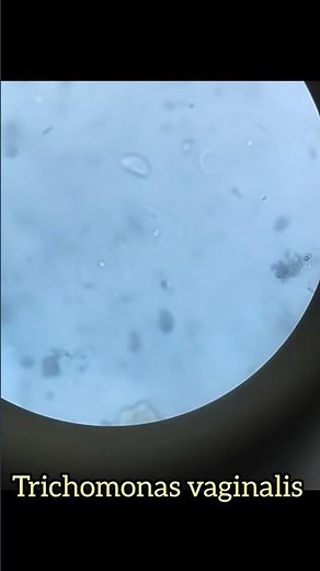 Trichomonas in urine |urine slide preparation | #microbiology #parasite#urine #analysis #microscope
