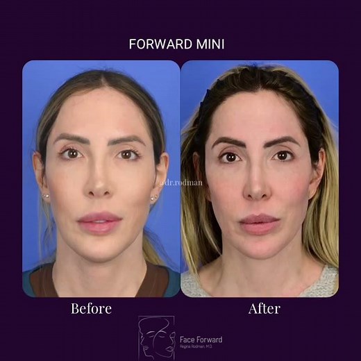 Forward Mini| Neck Lift| LTuck| Plastic Surgery| Houston, TX