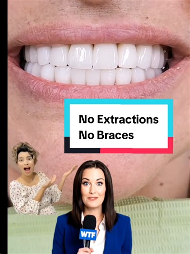 ✅ Cosmetic correction with veneers after bite opening can give patients a dramatic transformation but stability comes from careful diagnosis, mock-ups, and respecting function (TMJ, airway, and muscles).@Magical Smiles ☎ text/ Mob/ what's app  61481818957 📞 Ph: 03- 83582565 🌎 www. magicalsmiles.com.au#CapCut