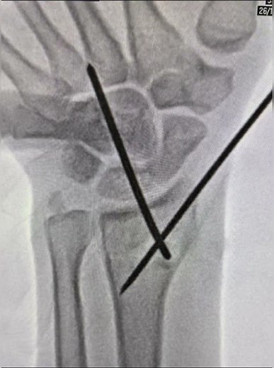 Kapandji reduction Distal radius fracture - Reduction technique