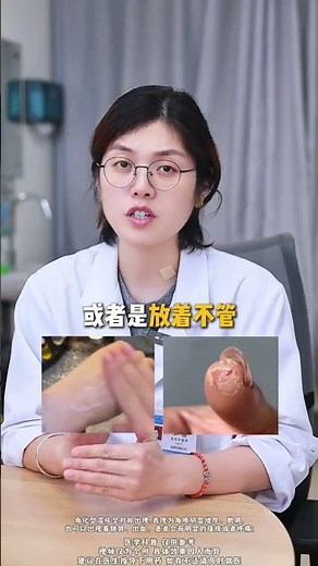 手上皮肤开裂还刺痛.可能不是单纯的皮肤干燥.其实是角化型湿疹 #角化型湿疹 #皮肤病 #皮肤 #健康科普 #手脱皮