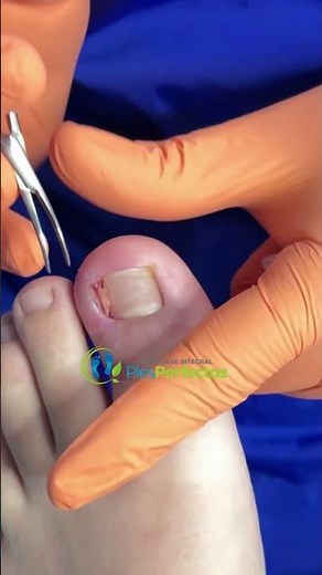 14-year-old patient with ingrown toenail (onychocryptosis) #ingrownnail #onychocryptosis #ingrown...
