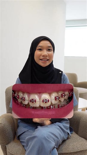 Warna Braces Terbaik: Pilihan Light Pink dan Blue