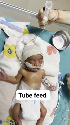 11K views · 419 reactions | Tube feeding in nicu by nursing officer #baby #feed #newborn #nicu #afterbirth | Naveen Kumar | Facebook