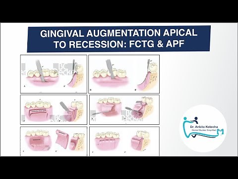 FREE CONNECTIVE TISSUE GRAFTS & APICALLY POSITIONED FLAP| GINGIVAL AUGMENTATION APICAL TO RECESSION