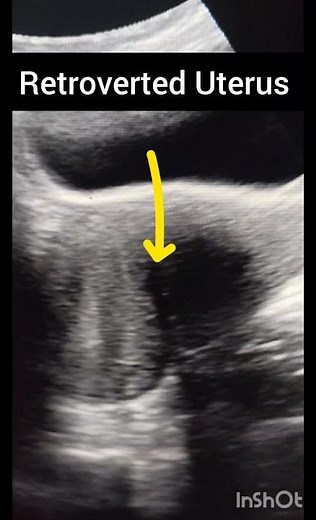 Ultrasound Pelvis! Pelvic Empowerment video! retroverted uterus!#ultrasoundmadeeasy86#radiology