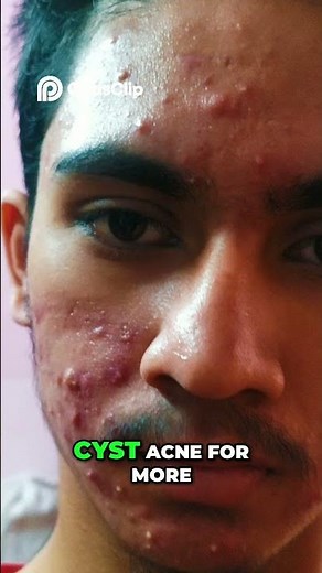 Blackhead Removal (How I Know Secret Of Blackhead)