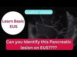 EUS Appearance of Solid and Cystic Pancreatic Lesions | Pancreatic Imaging Made Easy