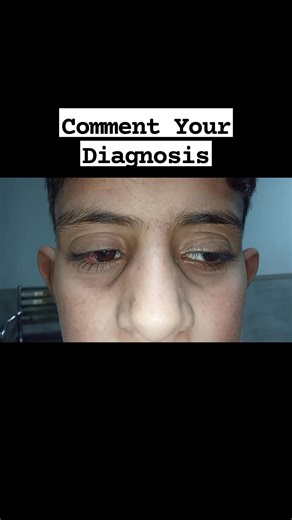 Comment Your Diagnosis and Observations. Optometry and Ophthalmology Videos. Eye doctor . #clinicaloptometry #eyecare #ophthalmology #fbviralpost2025シ #MedicalEducation #eye #postviralシ | Vision Scientist