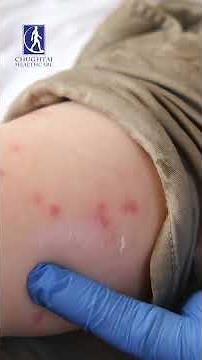 What are the signs and symptoms of Monkeypox? #monkeypoxsymptoms #monkeypox #chughtailab