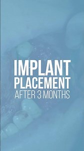 Lateral Augmentation of the Alveolar Ridge using Split Crest Technique