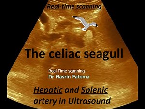 The celiac seagull in ultrasound II Seagull sign ultrasound II celiac artery branches ultrasound