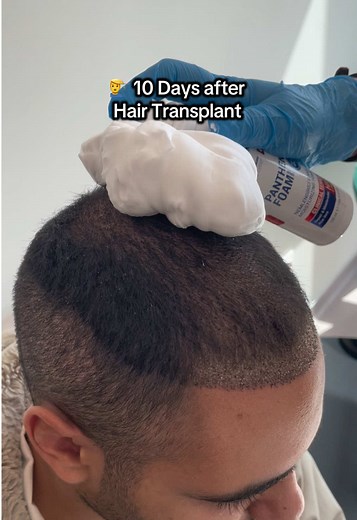 #creatorsearchinsights how to remove scabs after hair transplant? Safe scab shedding tutorial. #hairtransplant #HairTransplantSurgery
