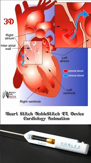 Heart Stitch NobleStitch EL Device | Cardiology Animation #medical #3d #animation #short