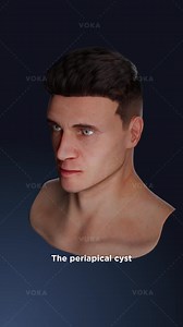 8.9K views · 59 reactions | What is a periapical true cyst? Causes,...