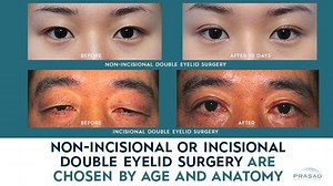 How Non-Incisional or Incisional Asian Double Eyelid Surgery are Chosen by Age and Anatomy