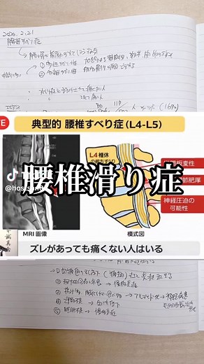 腰椎すべり症の概要と治療法