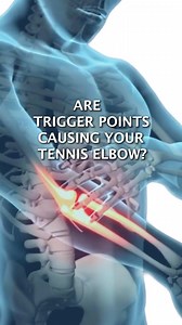 18K views · 344 reactions | Are Trigger Points Causing Your Tennis...