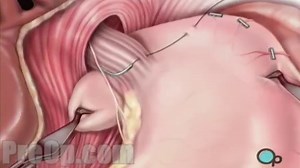 Nissen Fundoplication Surgery - Houston Heartburn Center