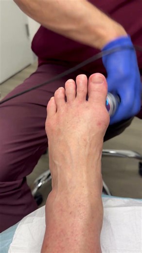Laser treatment post bunionectomy surgery #science #bodywork #alchemena