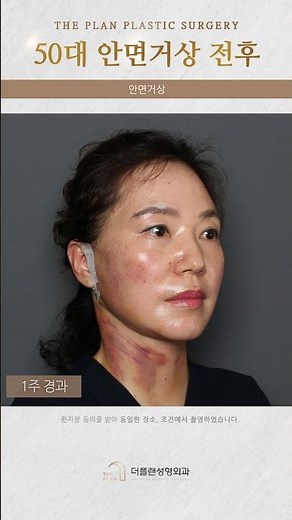 안면거상 50대 회복과정 공개! 부작용 주의하세요 #50대안면거상 #50대안면거상술 #리프팅효과