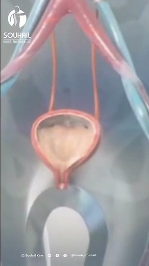 Tout ce que vous devez savoir sur l'endoprothèse urétérale 💡