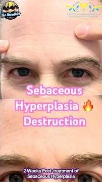 Sebaceous Hyperplasia 🔥 Destruction by PA Wang at Las Vegas Dermatology®