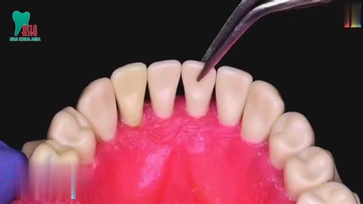 CỐ ĐỊNH RĂNG LUNG LAY BẰNG RIBBOND SAU KHI ĐIỀU TRỊ #trongrangimplantgiare #trongrangimplantuytin #bocrangsuuytin #TrồngRăngImplant #chiasekinhnghiem #nhakhoaasia #nhakhoaasia #chiasekienthuc | Nha Khoa Uy Tín | Facebook